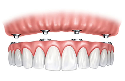 TeethXpress® By implanting 4 titanium artificial roots into your jawbone on the top or bottom of your mouth a denture is attached to give you realistic looking and functioning teeth.