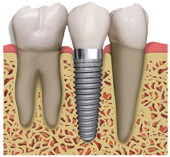 Dental Implants